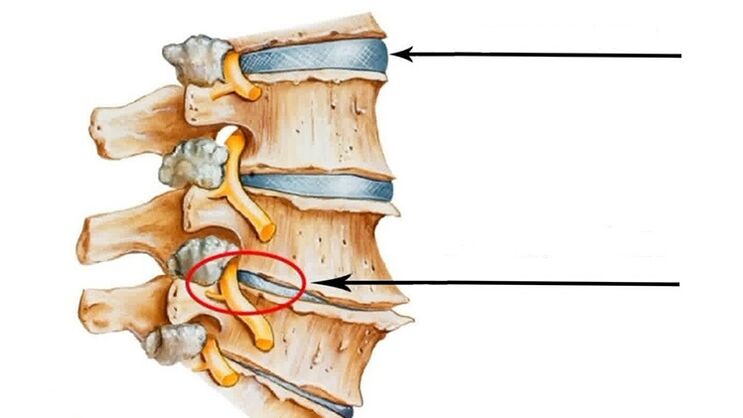 lesión espinal en caso de osteocondrosis cervical