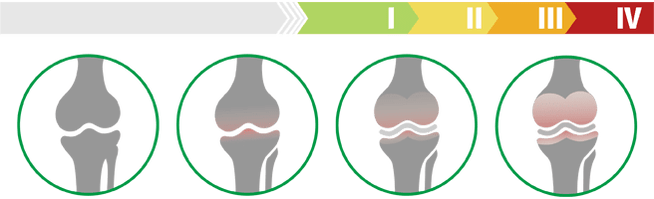 Etapas clínicas de la artrosis de la articulación de la rodilla (grado de artrosis de la articulación de la rodilla)