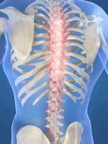 lesión espinal en caso de osteocondrosis torácica