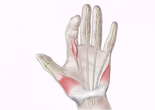 inflamación de los tendones como causa de dolor en las articulaciones de los dedos