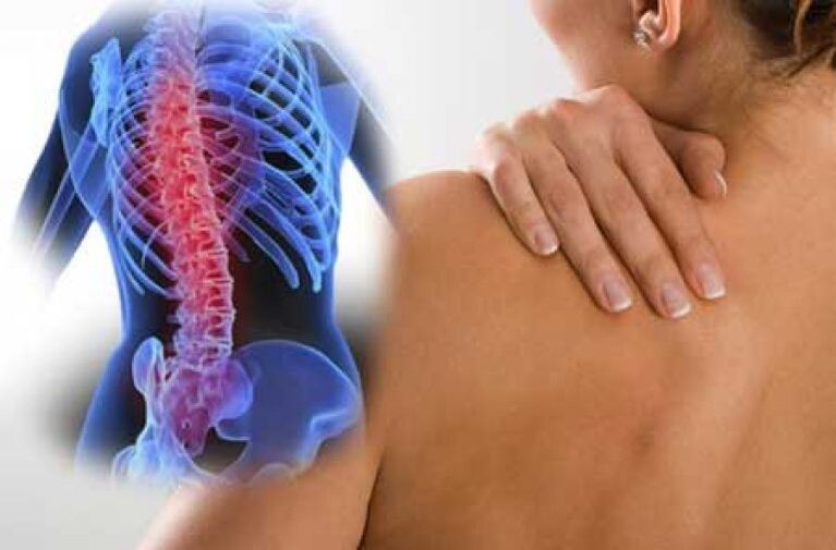 Durante una exacerbación de la osteocondrosis de la columna torácica, se produce dolor en el dorsago. 
