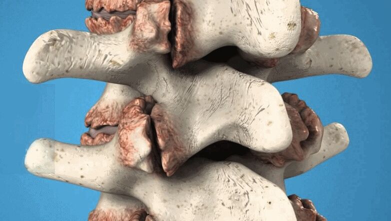 osteofitos espinales como causa de dolor lumbar