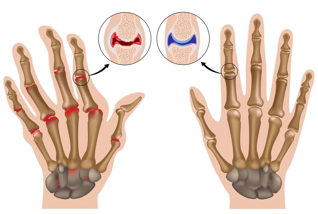 Articulaciones de las manos sanas y afectadas por poliartritis