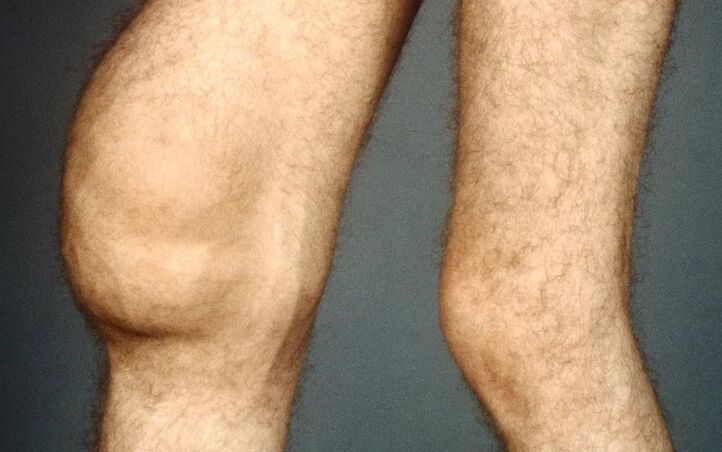 Artrosis post -trraumática de la articulación de la rodilla