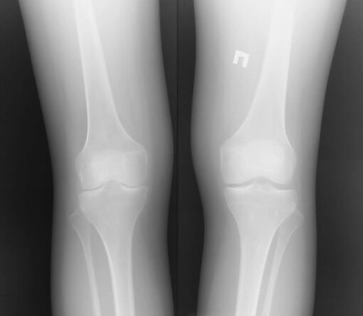La radiografía de la articulación de la rodilla