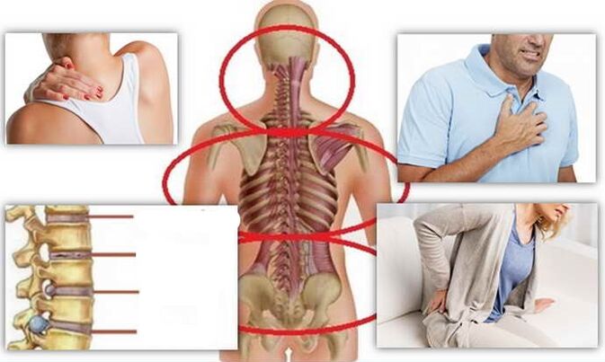 Lugares de enfermedad para la osteocondrosis