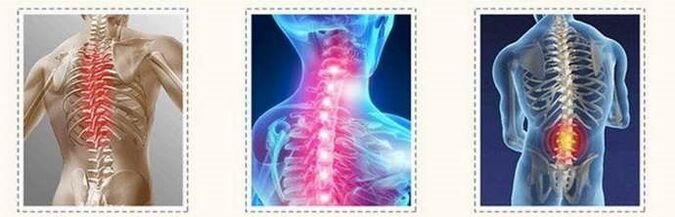 lesiones espinales de osteocondrosis