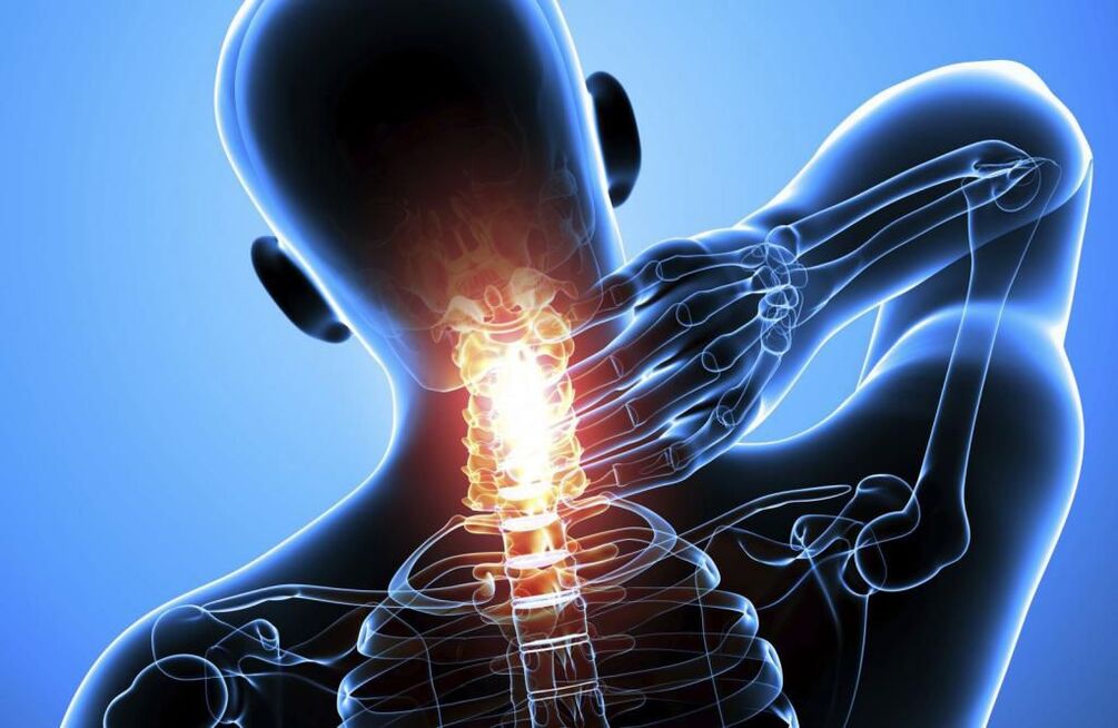 Osteocondrosis de la columna cervical.