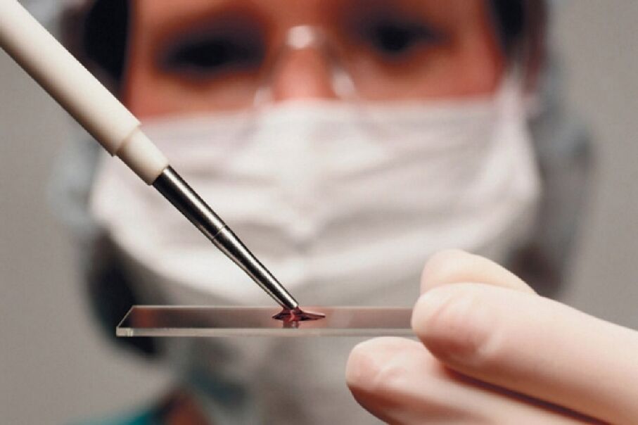 La artritis es una enfermedad inflamatoria y su presencia se revela mediante análisis de sangre.