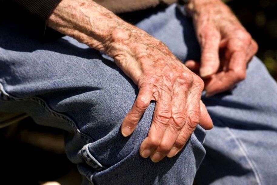 La artrosis es una enfermedad relacionada con la edad que se presenta en personas mayores.